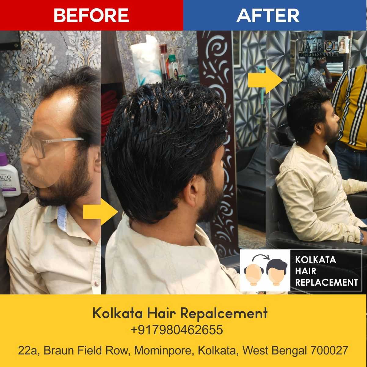 Home - Kolkata Hair Replacement