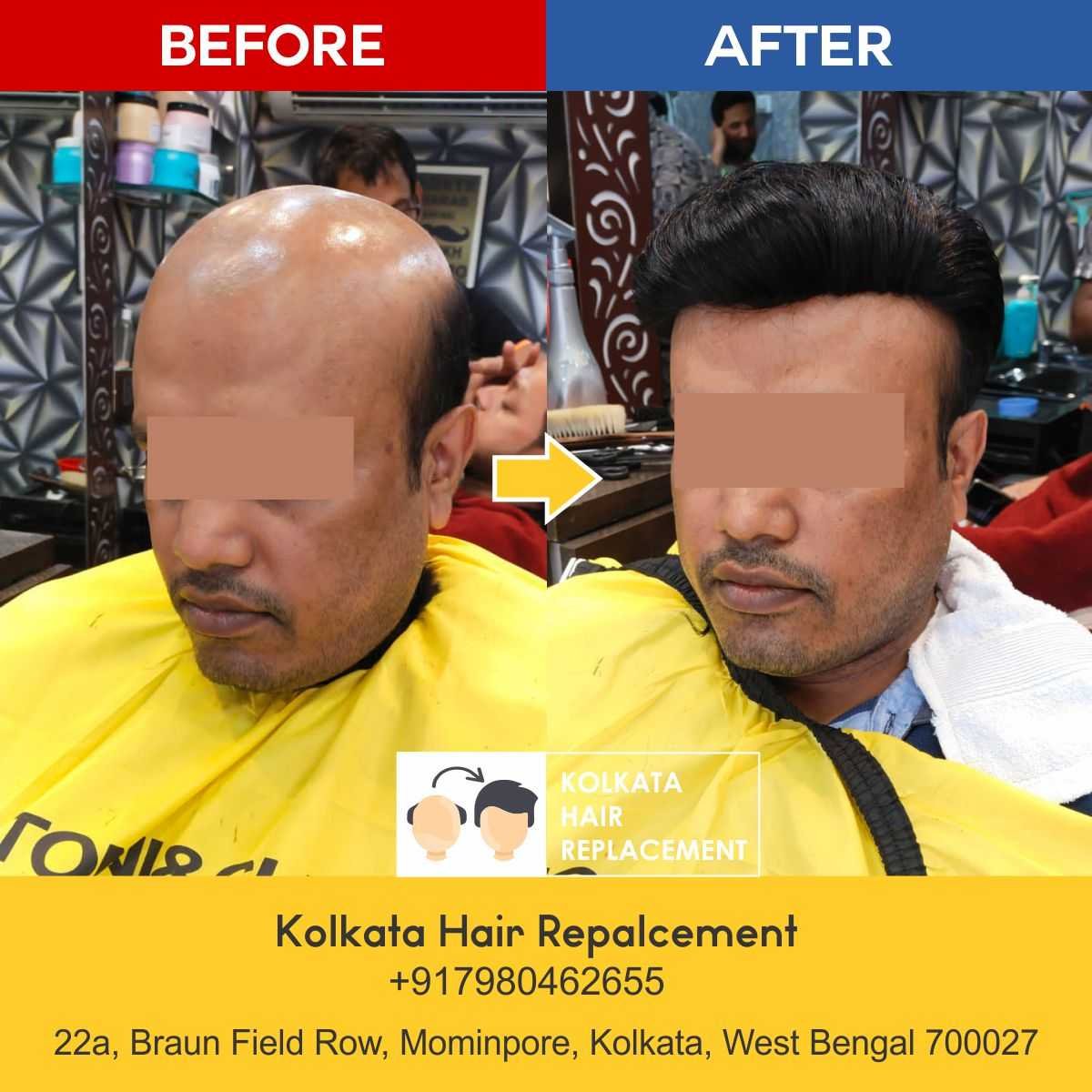 men-hair-wig-patch-kolkata-hair-replacement-before-after-02