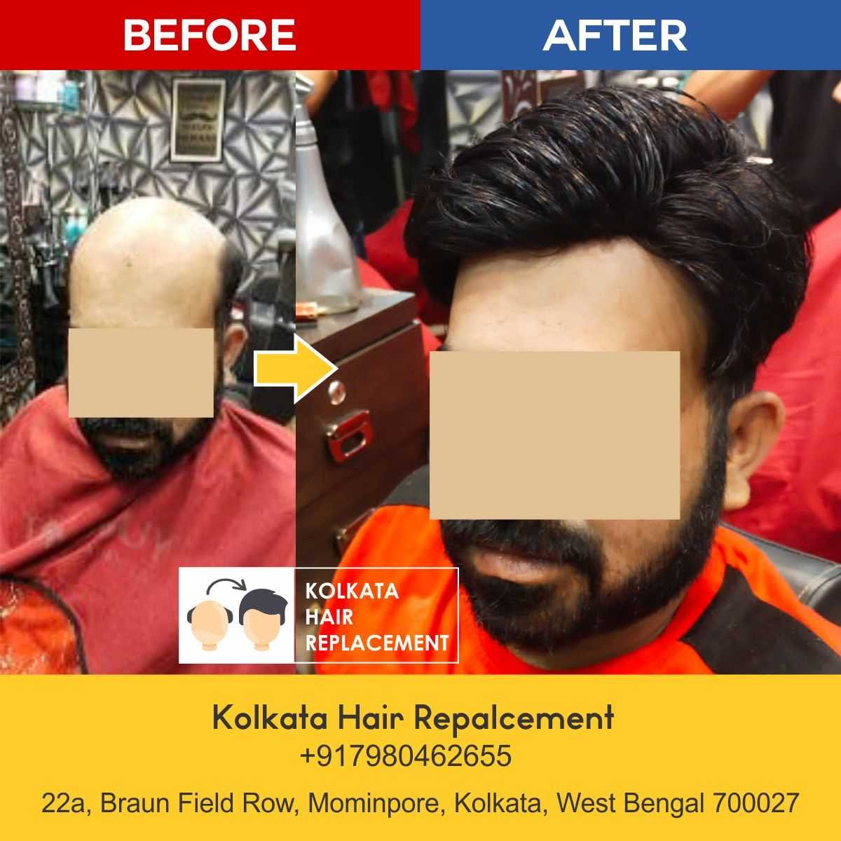 men-hair-wig-patch-kolkata-hair-replacement-before-after-04