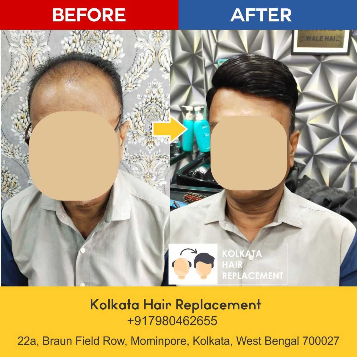 men-hair-wig-patch-kolkata-hair-replacement-before-after-05