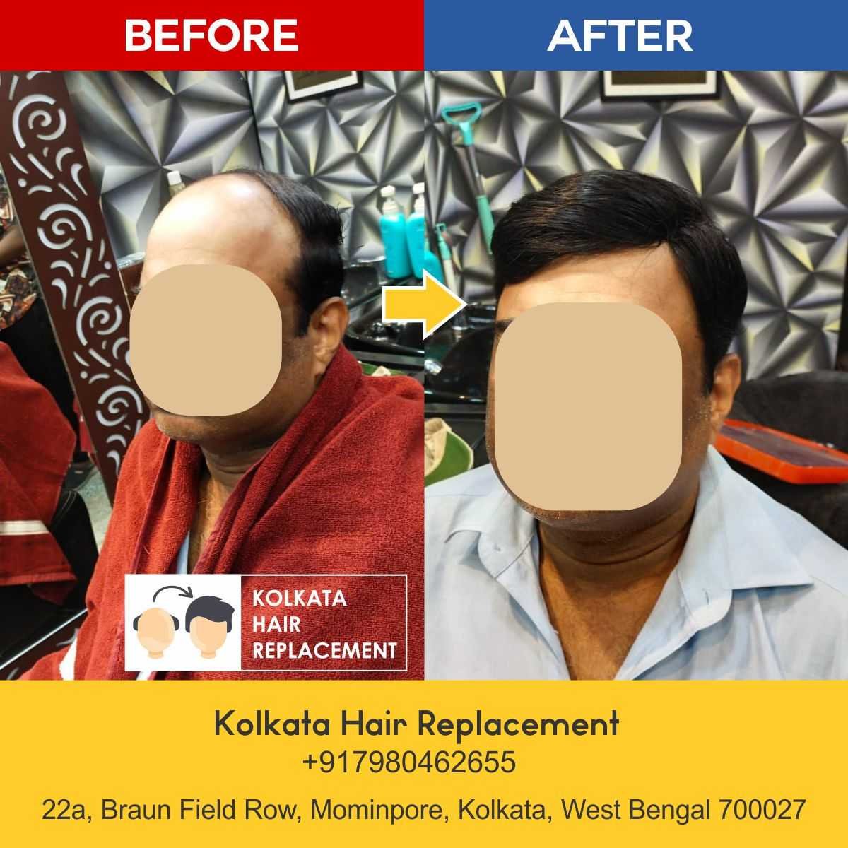men-hair-wig-patch-kolkata-hair-replacement-before-after-06