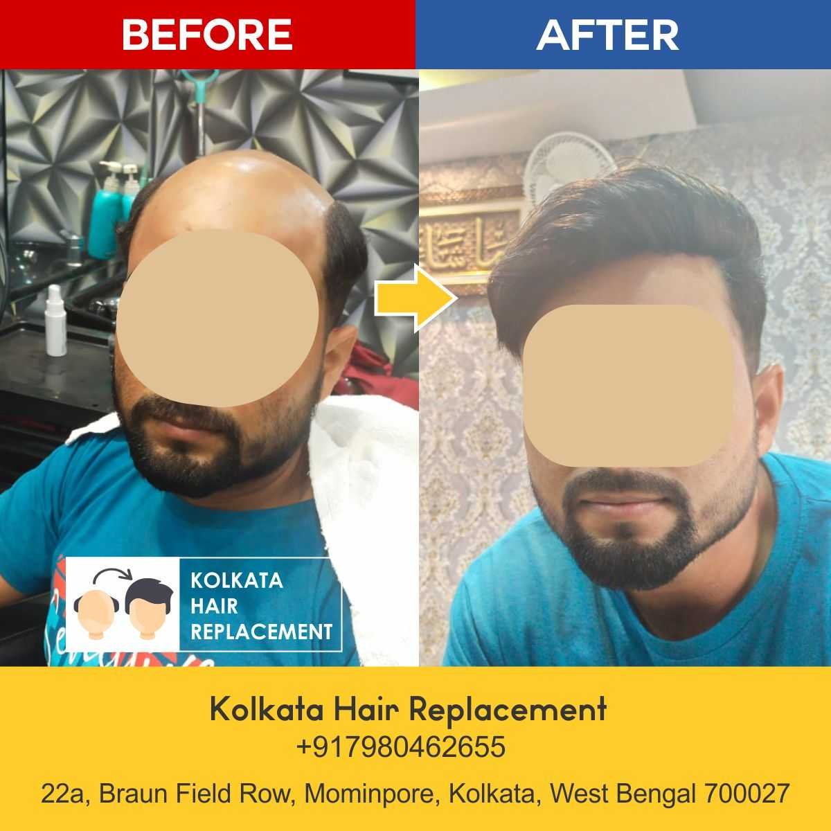 men-hair-wig-patch-kolkata-hair-replacement-before-after-07