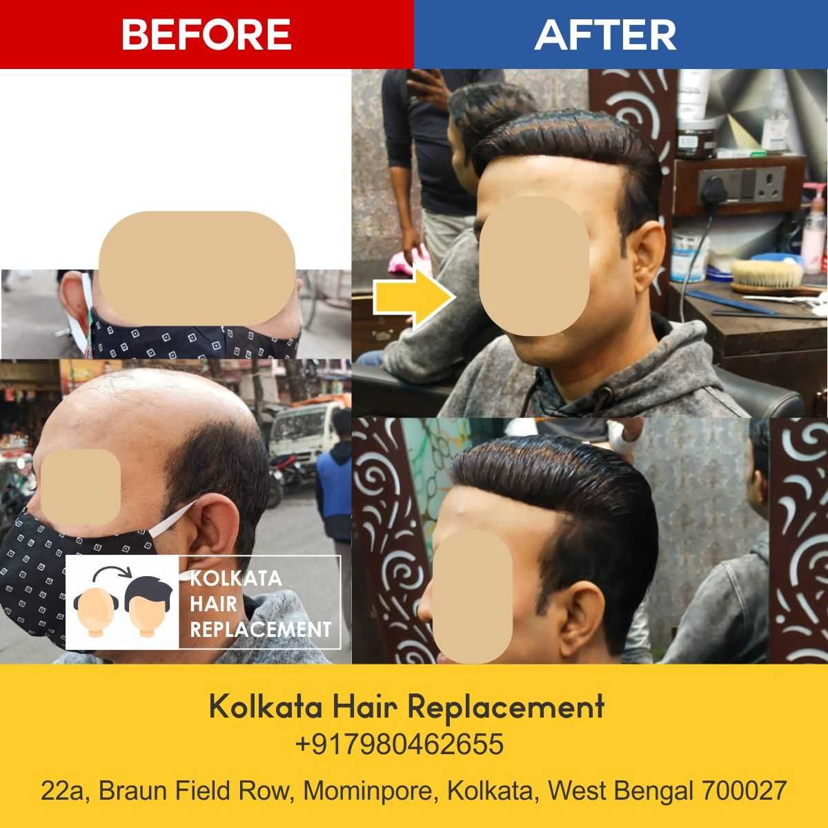 men-hair-wig-patch-kolkata-hair-replacement-before-after-08